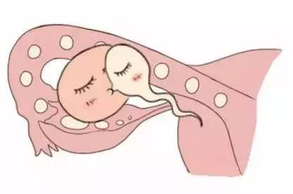 体外受精 IVF-ET